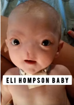 História do bebê que nasceu sem nariz nos EUA volta a chamar a atenção nas redes sociais